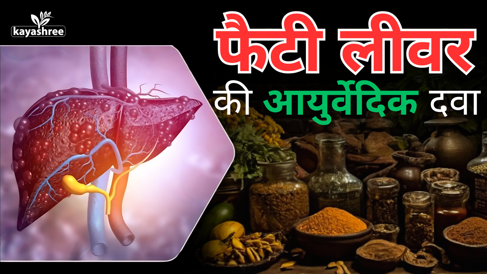 फैटी लीवर की आयुर्वेदिक दवा